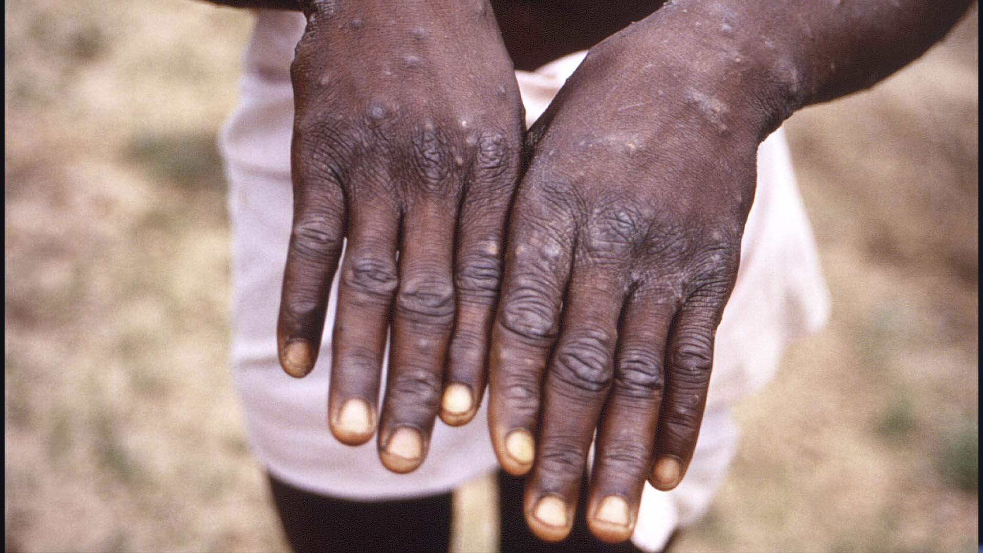 Au moment d’écrire ces lignes, plus d’une centaine de cas de la variole du singe — ou «monkeypox» — avaient été enregistrés à l’extérieur de l’Afrique, où cette maladie est endémique.