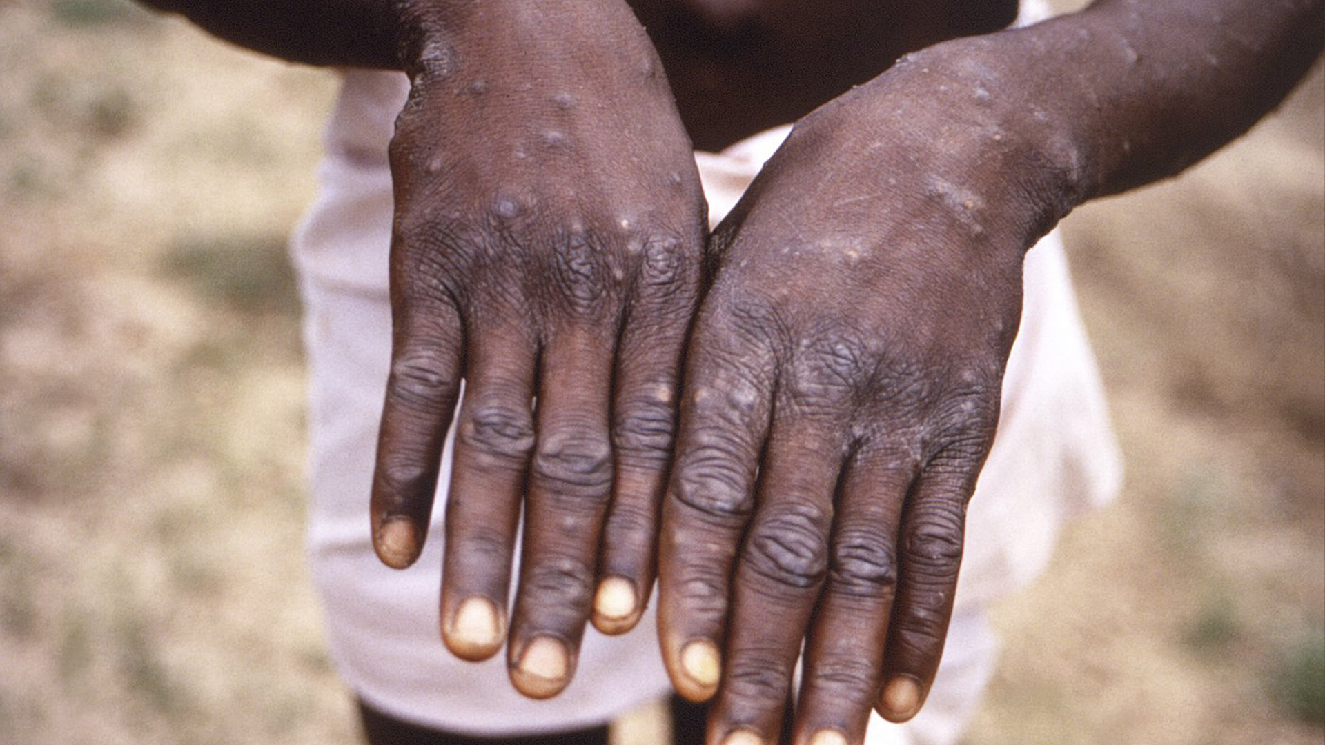 Cette image de 1997 fournie par le CDC représente les surfaces dorsales des mains d'un patient atteint de monkeypox, qui présentait l'apparition de l'éruption caractéristique au cours de sa phase de récupération.