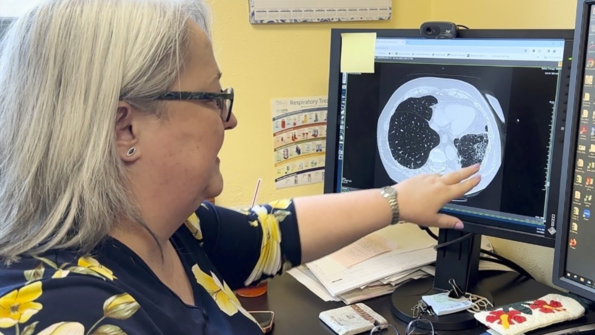 Le Dr Lee Morissette montre une image de poumons endommagés par l'exposition à l'amiante, au Centre des maladies liées à l'amiante, le jeudi 4 avril 2024, à Libby, dans le Montana. 