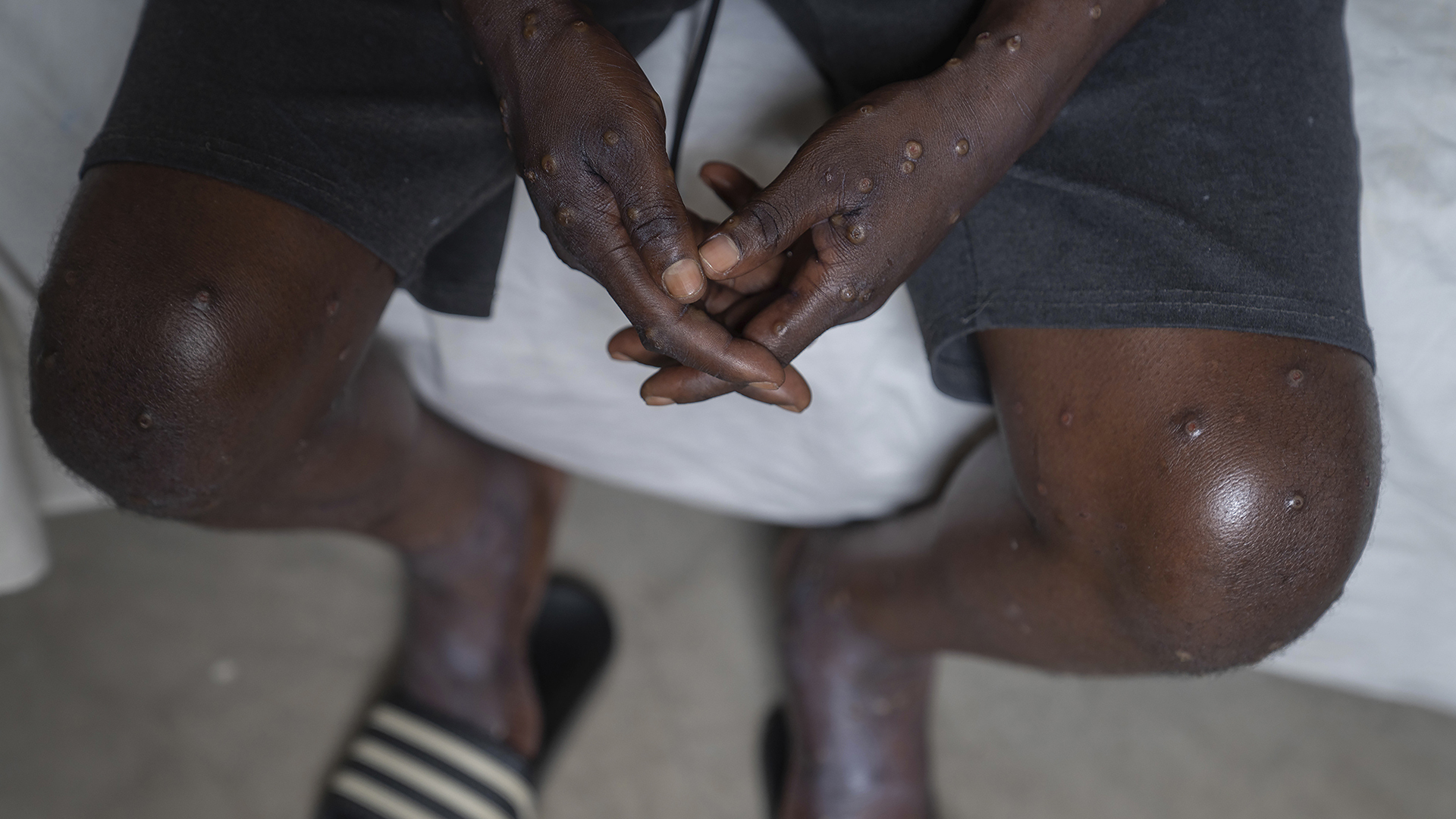 Un homme non identifié infecté par la variole à l'hôpital général de Goma, en République démocratique du Congo, le 16 juillet 2024, où il poursuit son traitement. 